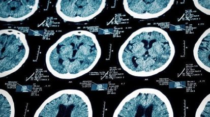 MRI-scans